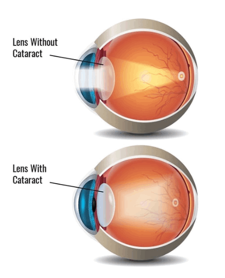 Eye with cataract and eye without cataract