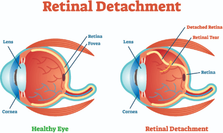 Retinal Detachment