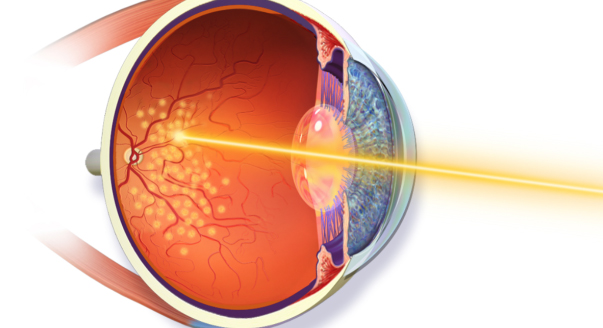 Retina Laser Surgery For Treating Diabetic Retinopathy and fFloaters In Eye