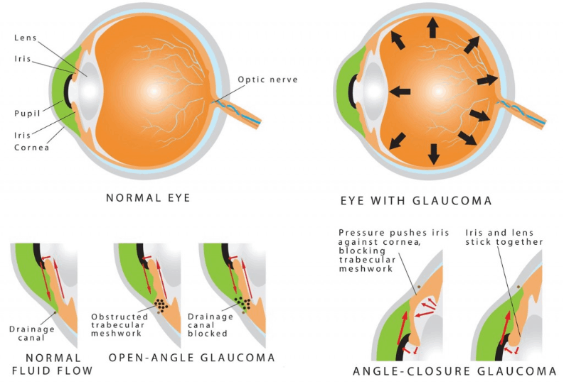 Eye with glaucoma, a condition that leads to seeing black dots